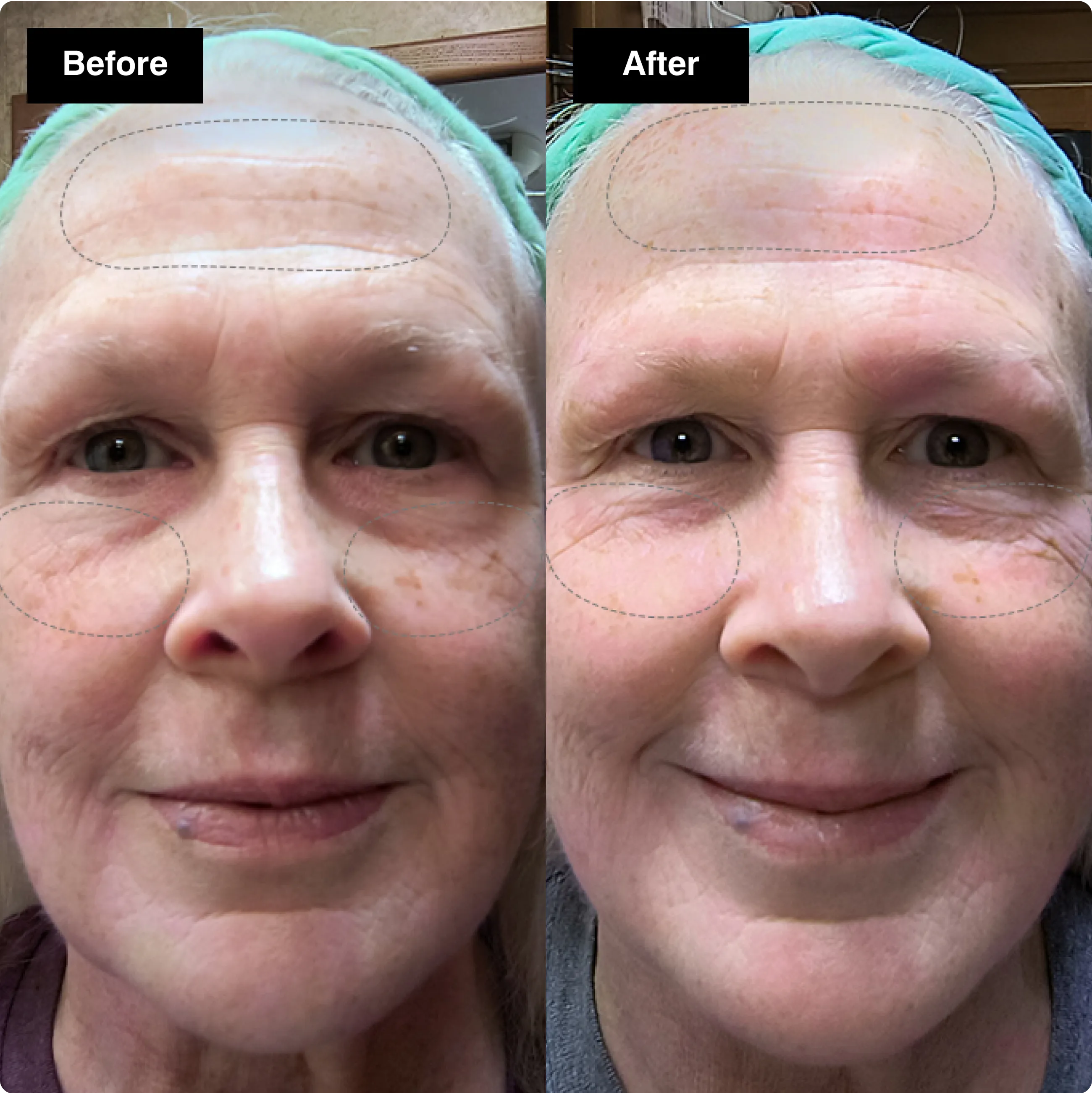 Before and after skincare comparison of a
woman's forehead and under-eye area,
showing reduced fine lines.​