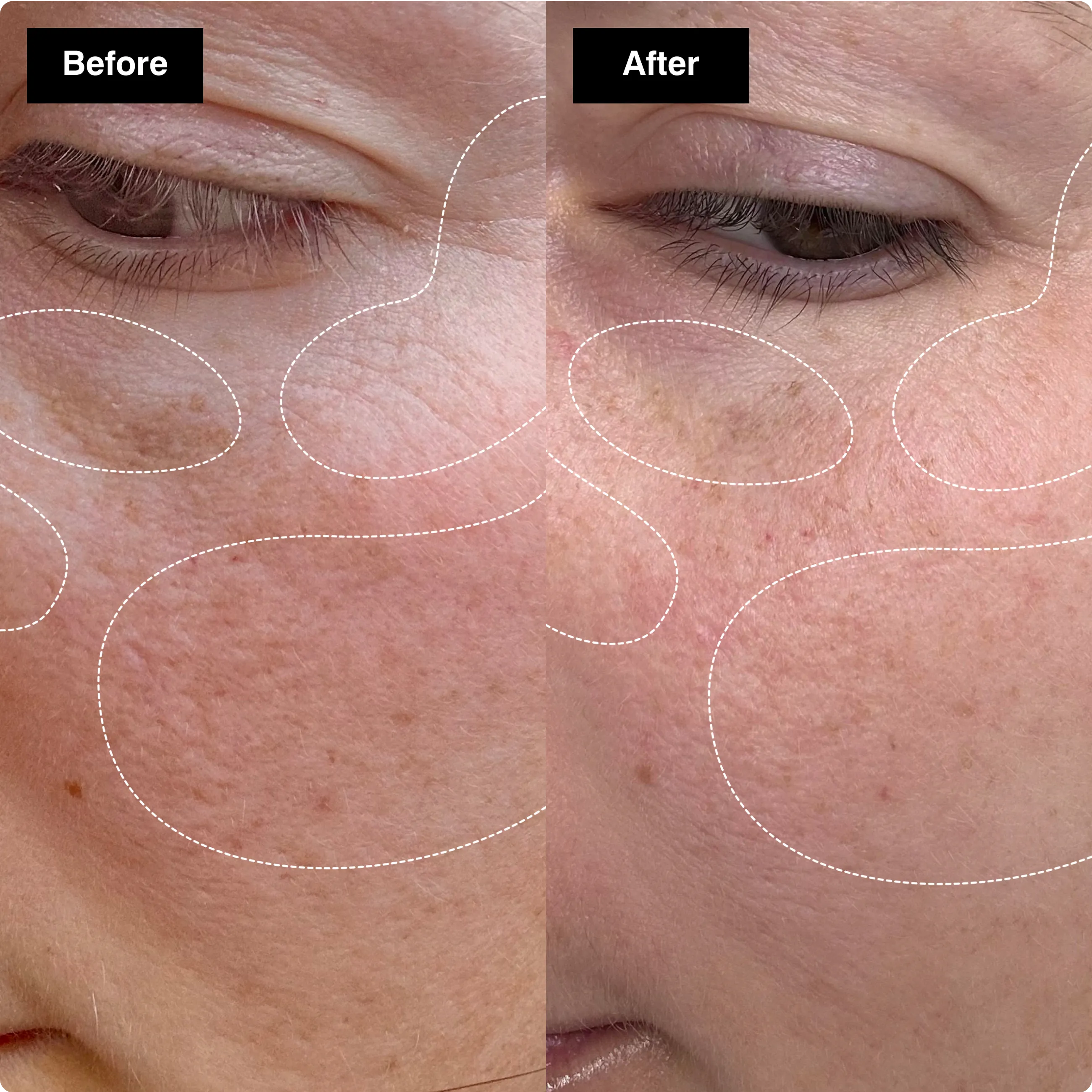 Before and after close-up comparison
showing improved skin texture and
reduced dark spots under the eye.​