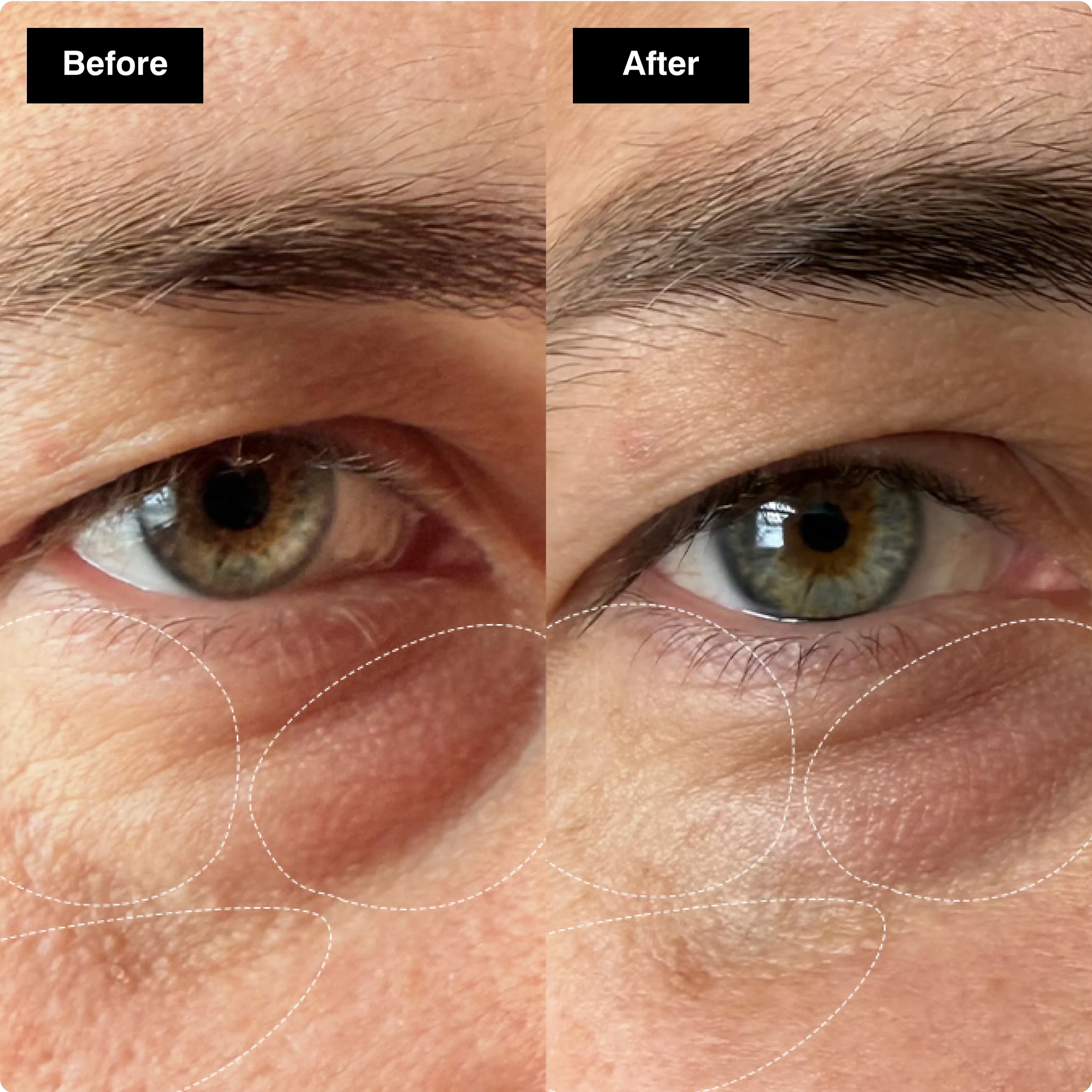 Before and after close-up comparison of an eye area, showing reduced under-eye bags and smoother skin.​