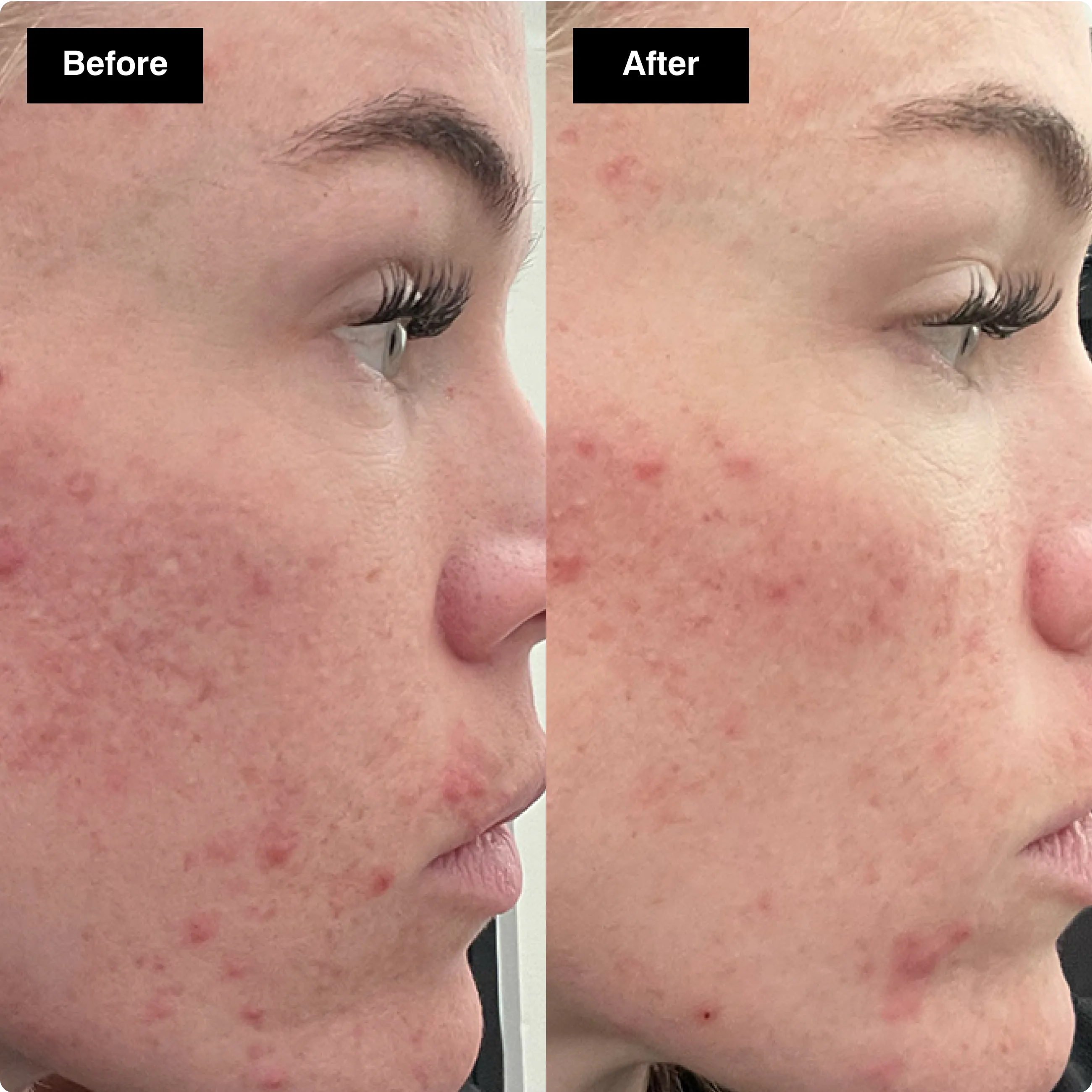 Before and after skincare comparison
showing a side profile with significantly
reduced acne redness on the cheek.​