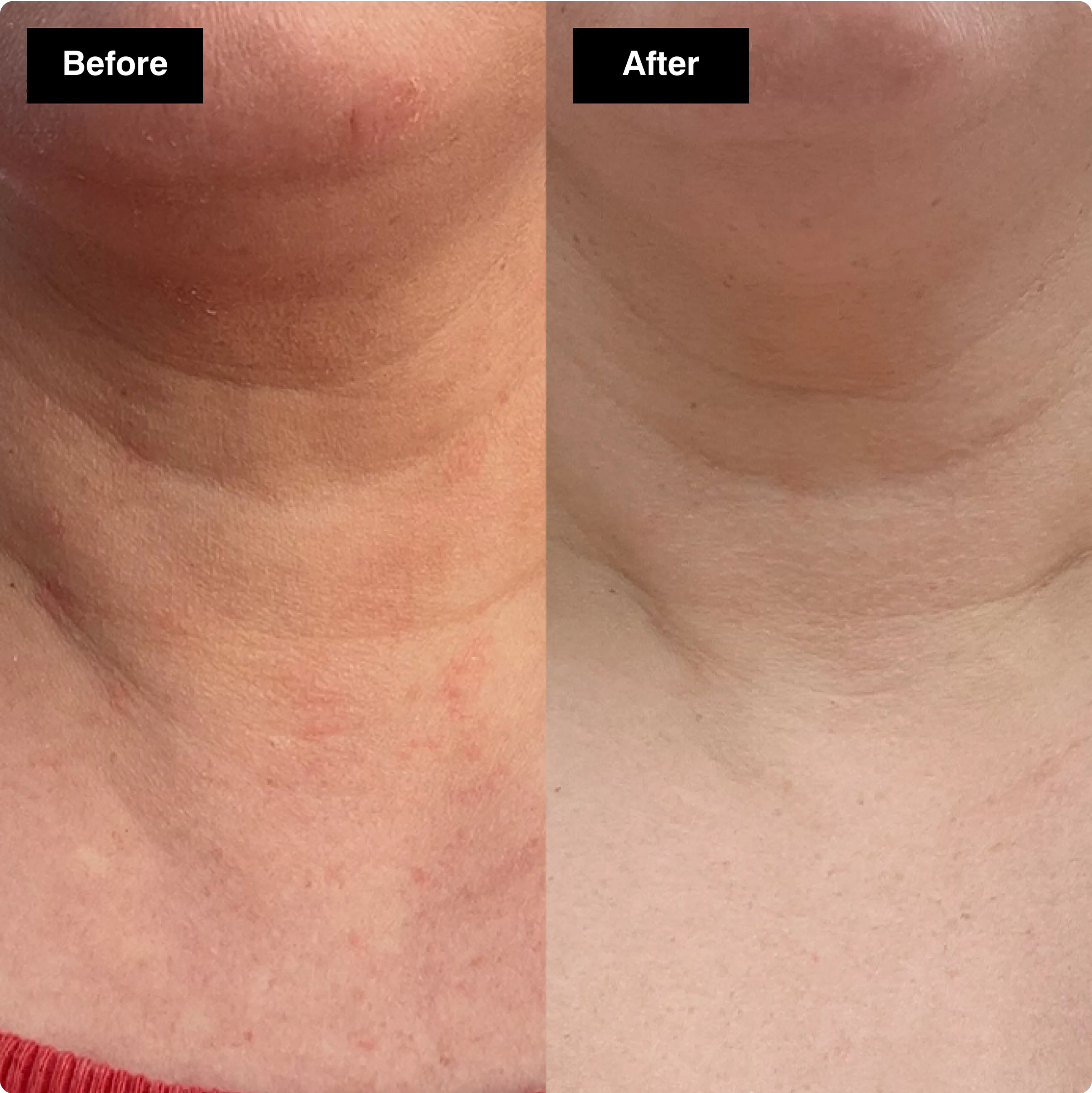 Before and after skincare comparison
showing reduced redness and smoother
texture on a person's neck.​