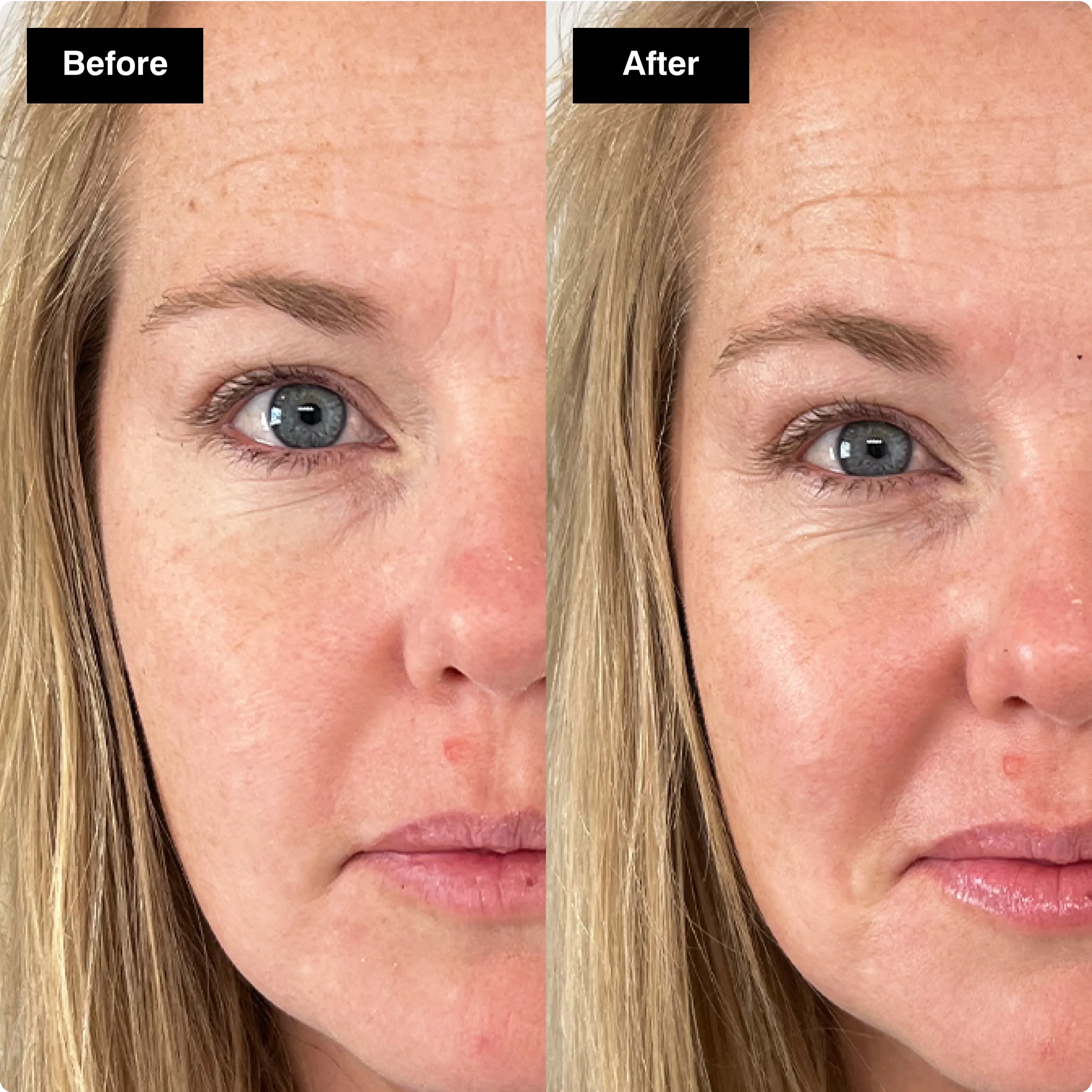 Before and after skincare comparison
showing a visible reduction in fine lines
and wrinkles around the eye.​