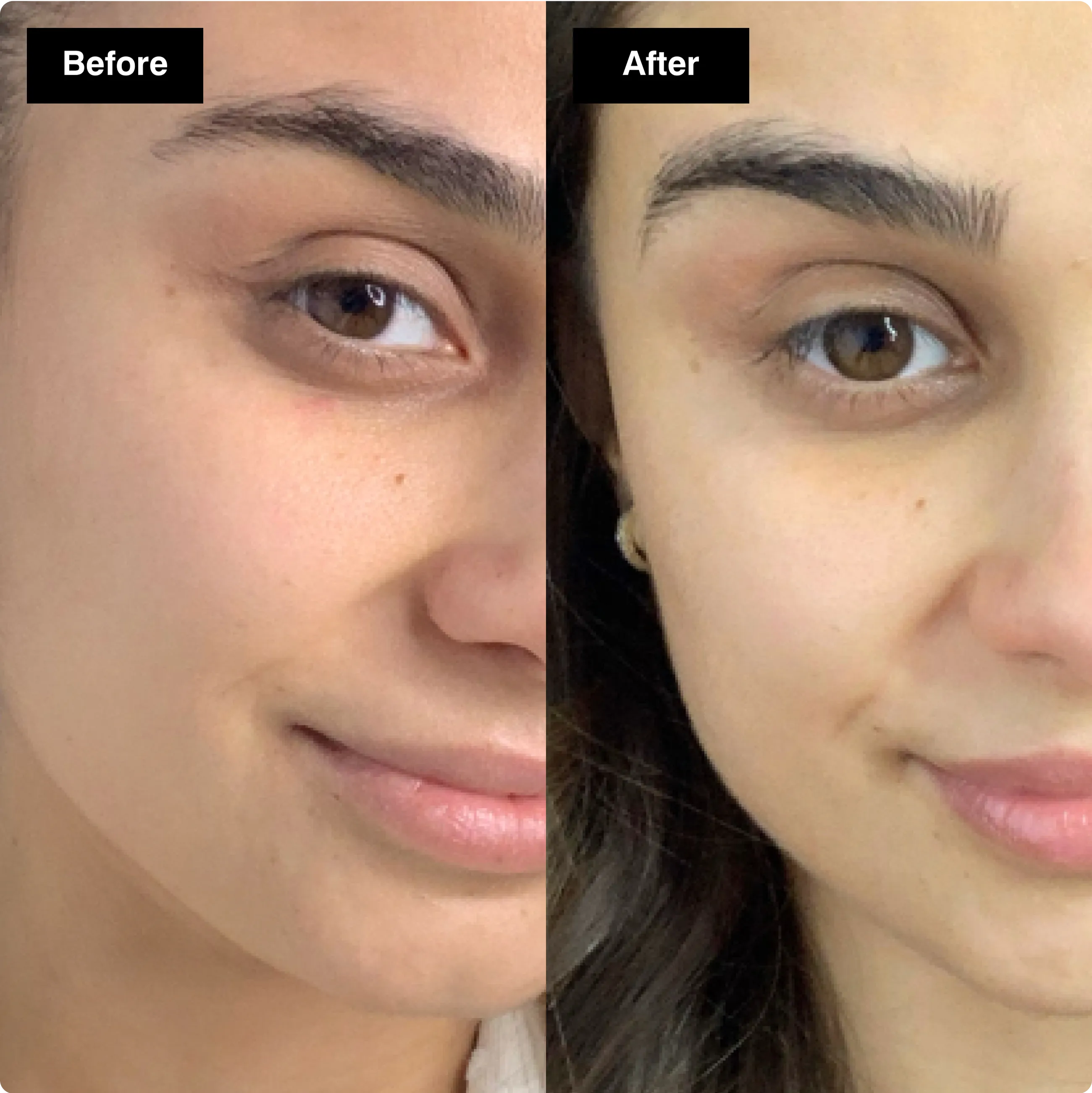 Before and after skincare comparison
showing a brighter, smoother under-eye
area with reduced dark circles.​