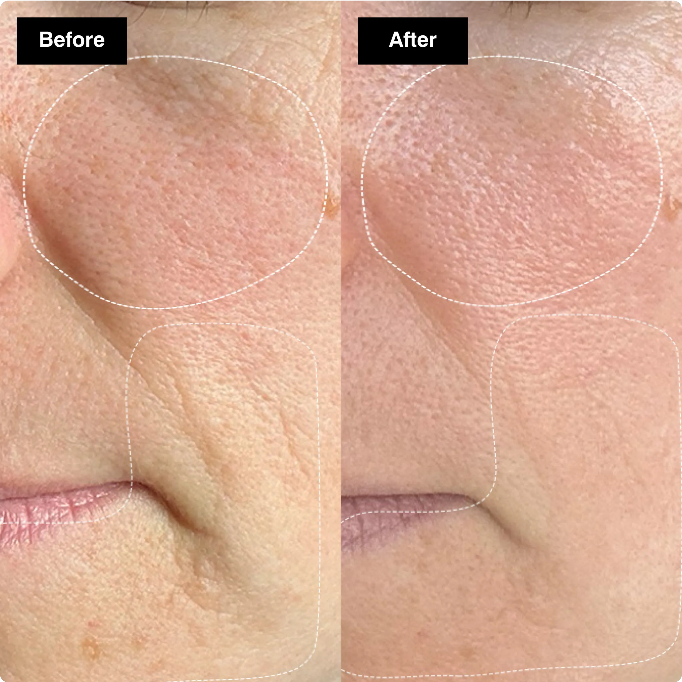 Before and after skincare comparison
showing a side profile with an visibly
brighter, smoother, and more glowing
cheek.​