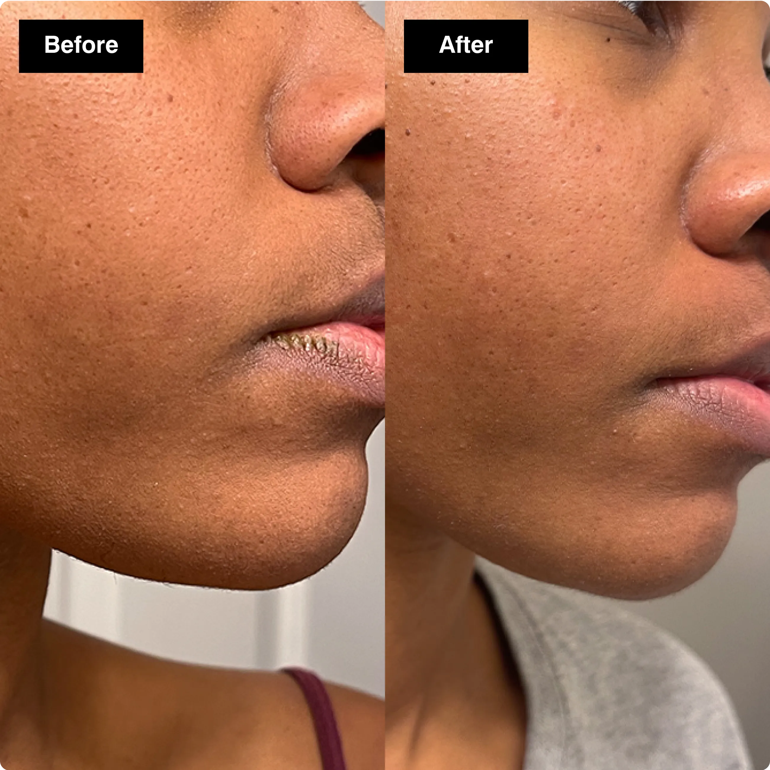 Before and after skincare close-up showing
skin that looks visibly more plump,
hydrated, and deeply moisturized.​