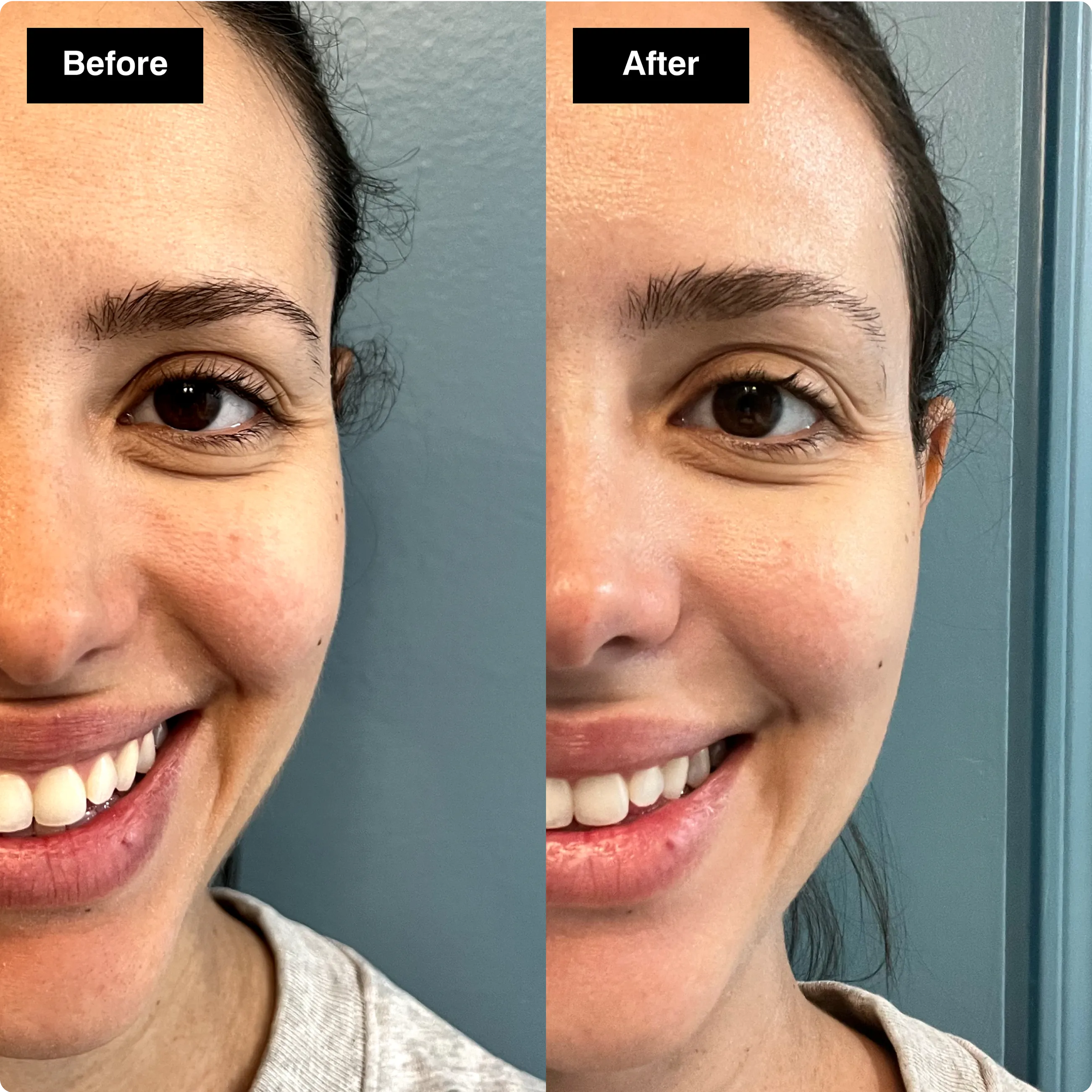 Before and after skincare comparison of a
woman's eye area, showing lightened dark
circles and a smoother look.​