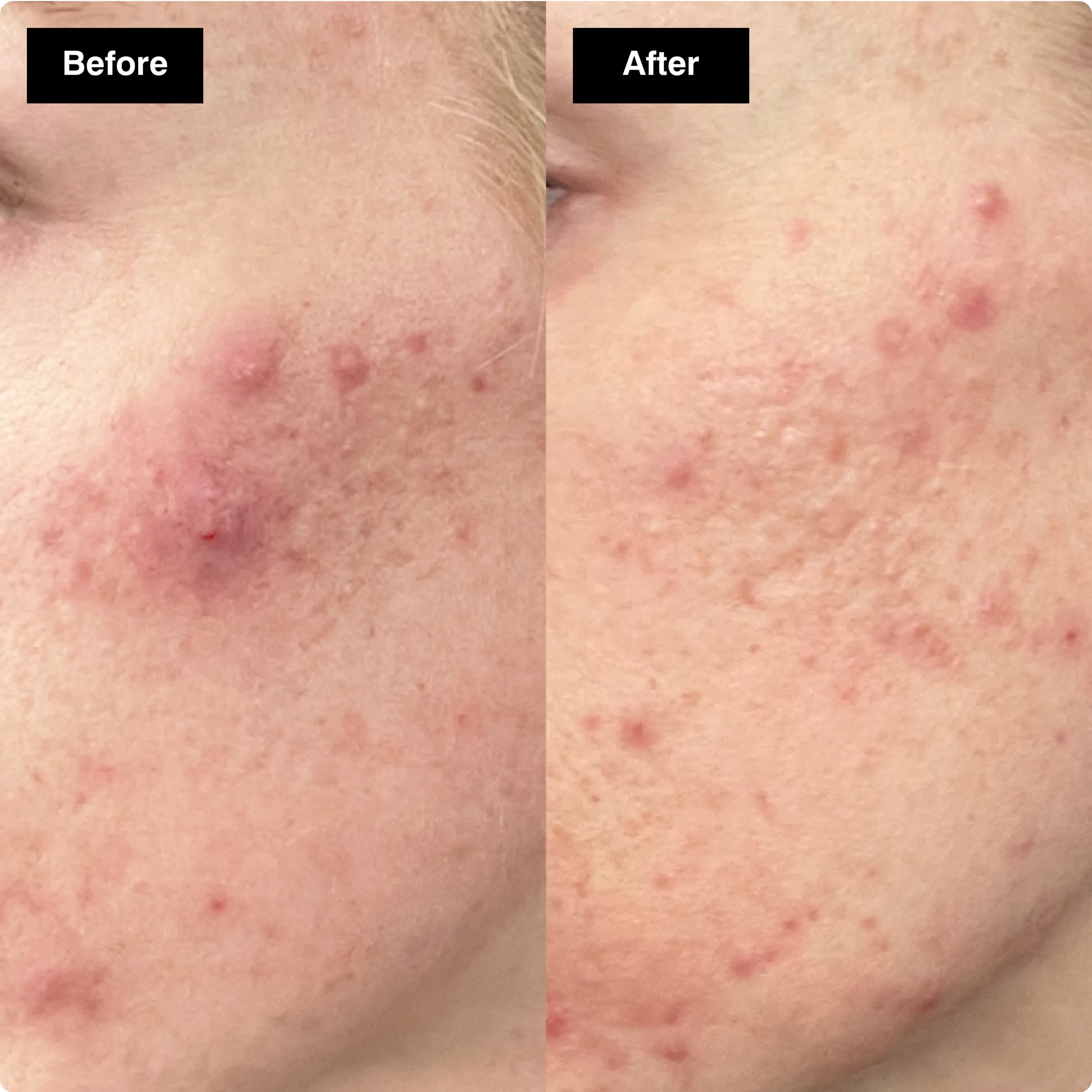 Before and after skincare comparison
showing a noticeable reduction in a large,
inflamed cystic acne breakout.​