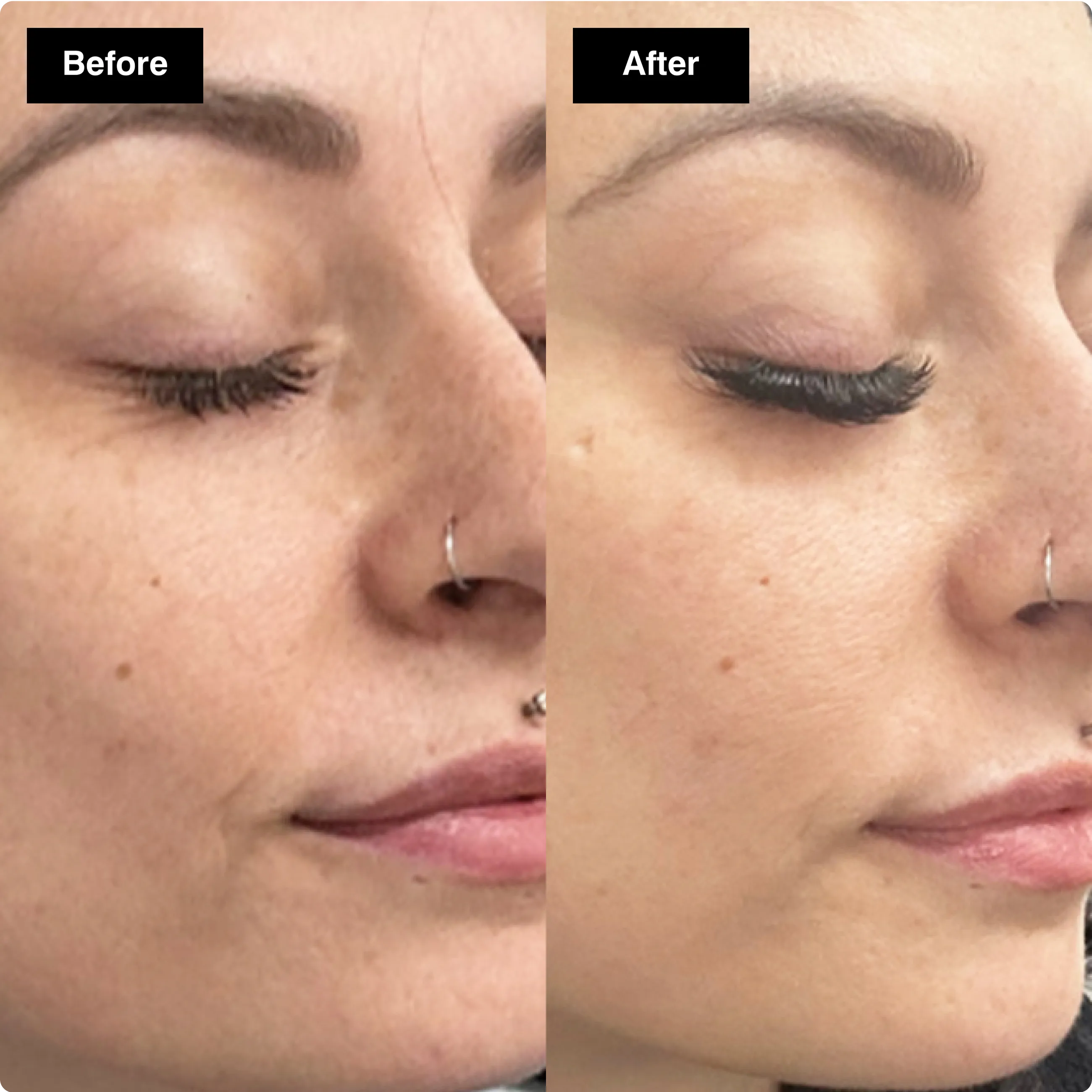 Before and after skincare comparison of a
woman's cheek showing smoother skin
and faded dark spots.​