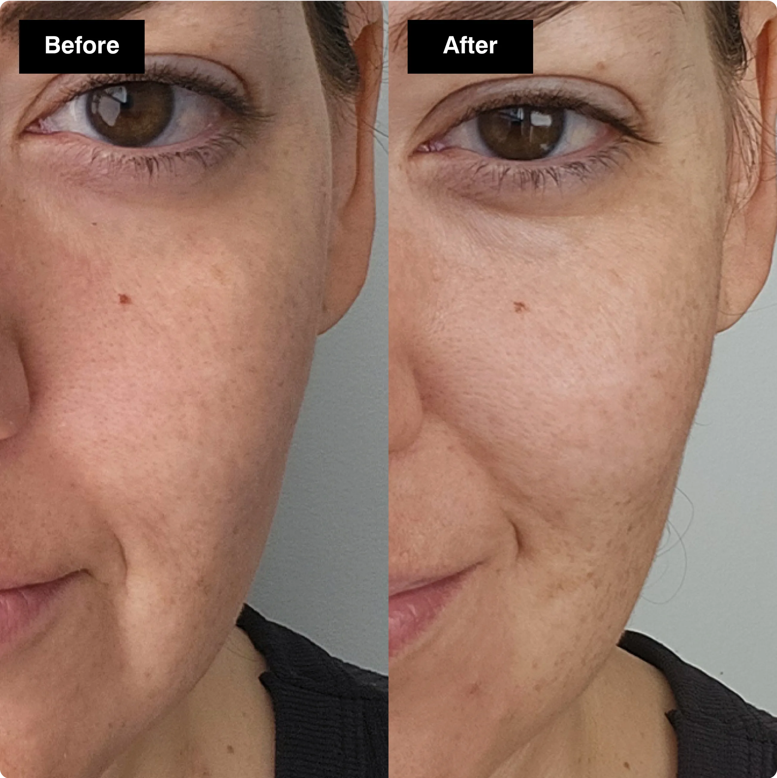 Before and after skincare comparison
showing smoother skin texture and a
brighter, more refreshed complexion.​