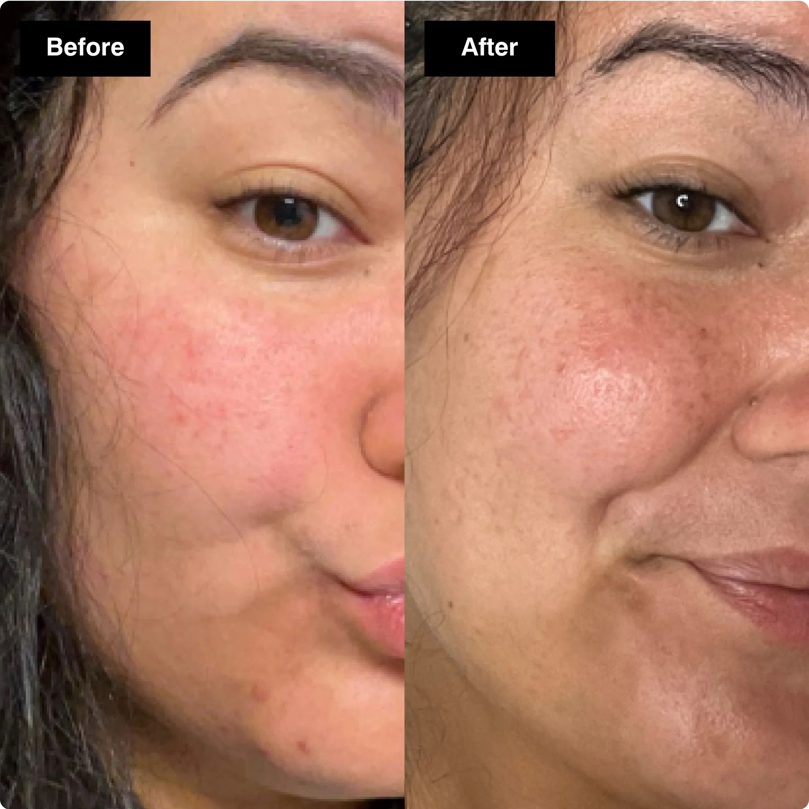 Before and after skincare close-up of a
woman's cheek, showing a reduction in
redness and irritation. here​