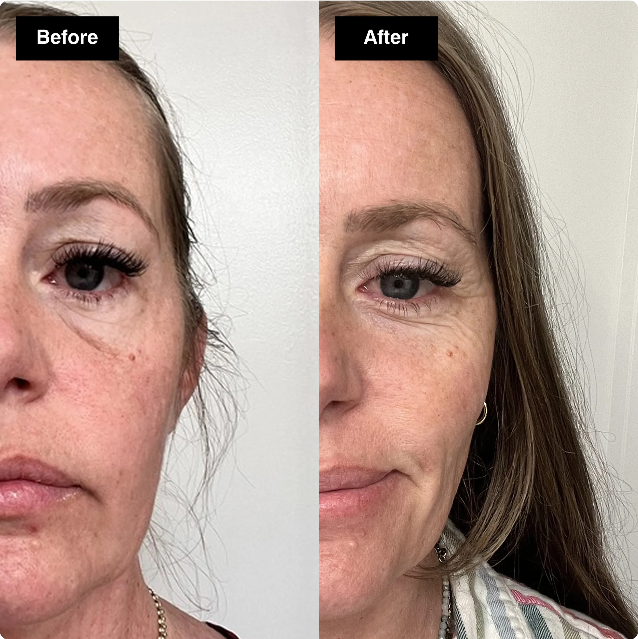 Before and after skincare comparison
showing a visible reduction in fine lines
and wrinkles around a woman's eye area.​