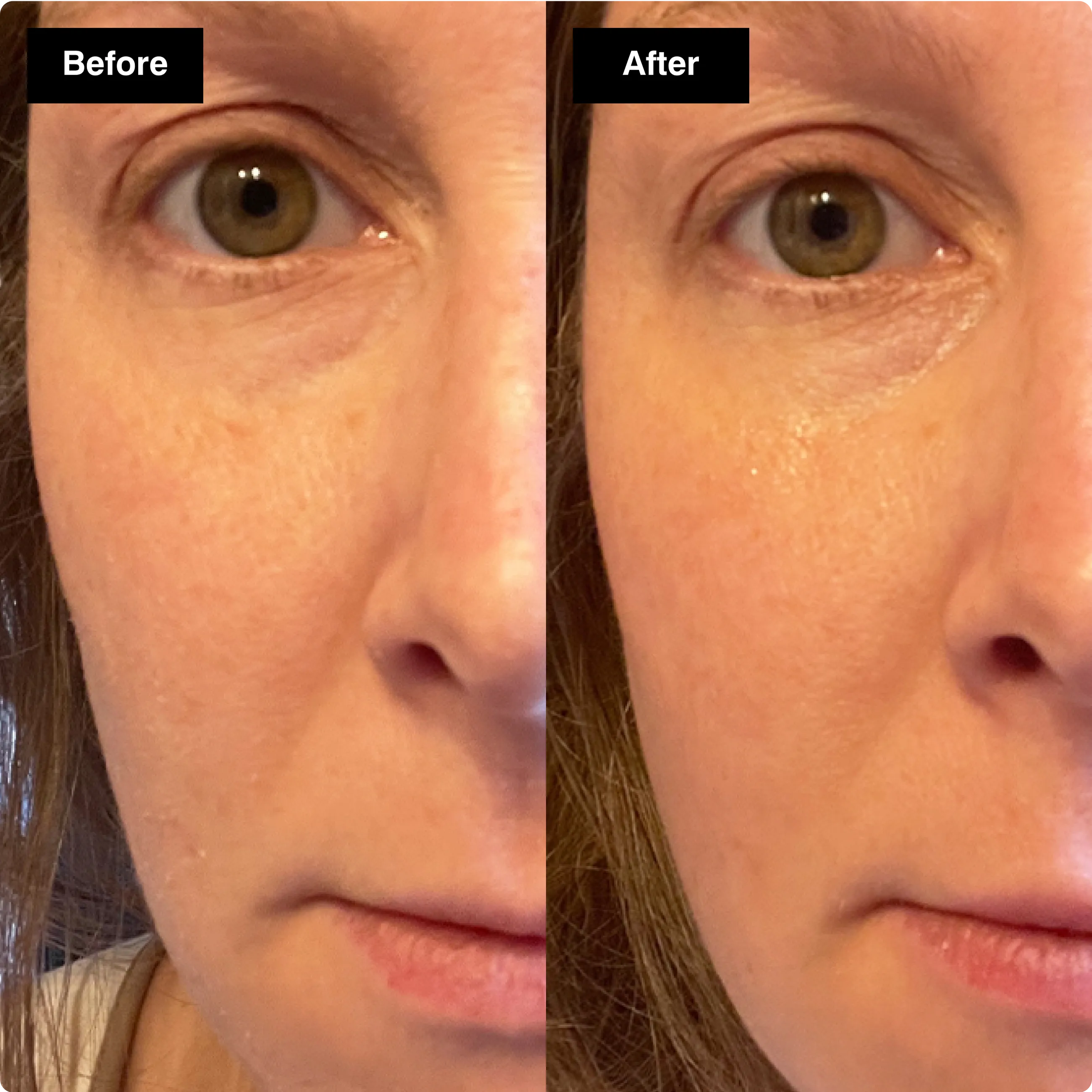 Before and after side-by-side comparison
showing improved skin texture under the
eye.​
