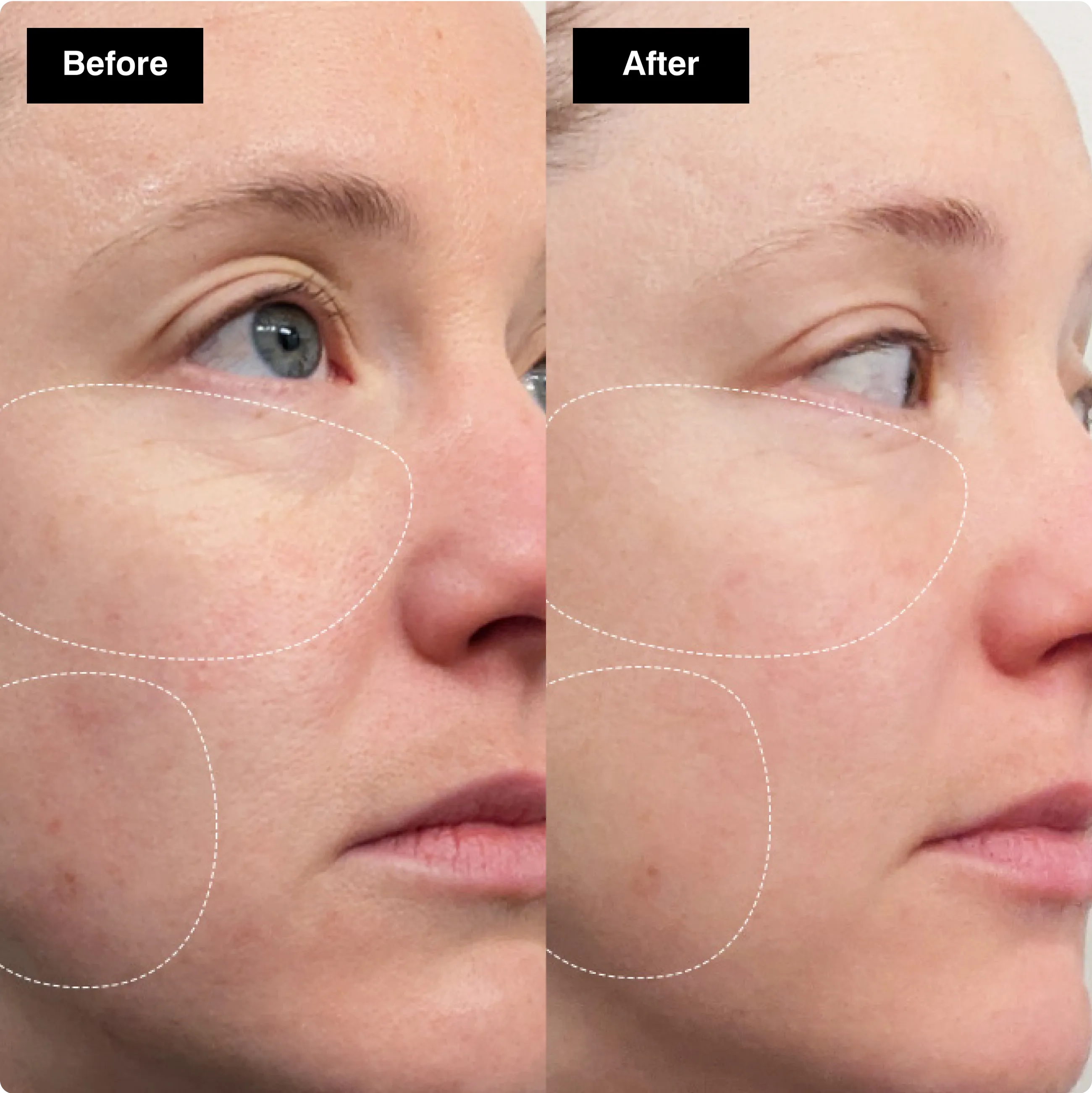 Before and after skincare comparison
highlighting smoother skin texture around
a woman's eye and cheek.​