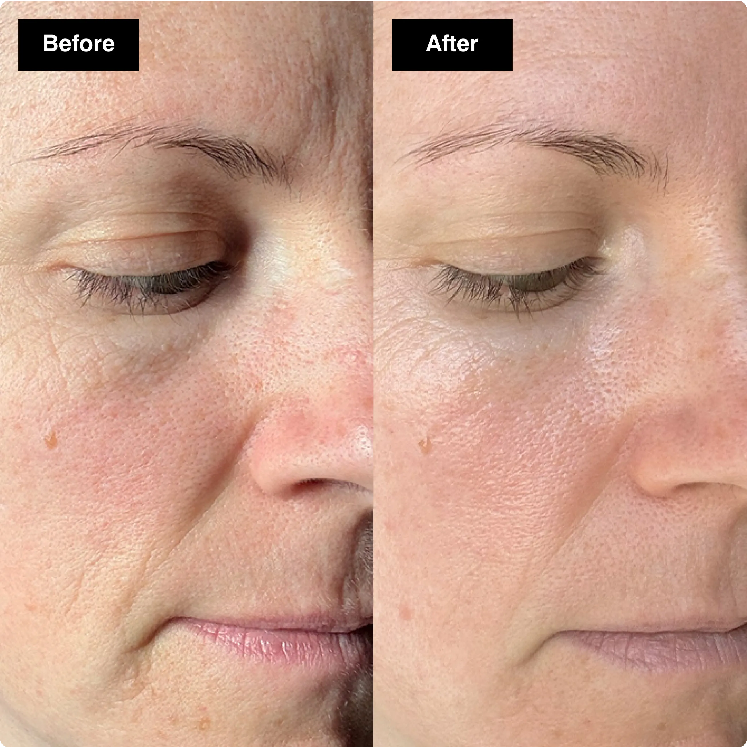 Before and after close-up comparison of a
woman's face, showing a visible reduction in
wrinkles and fine lines.​