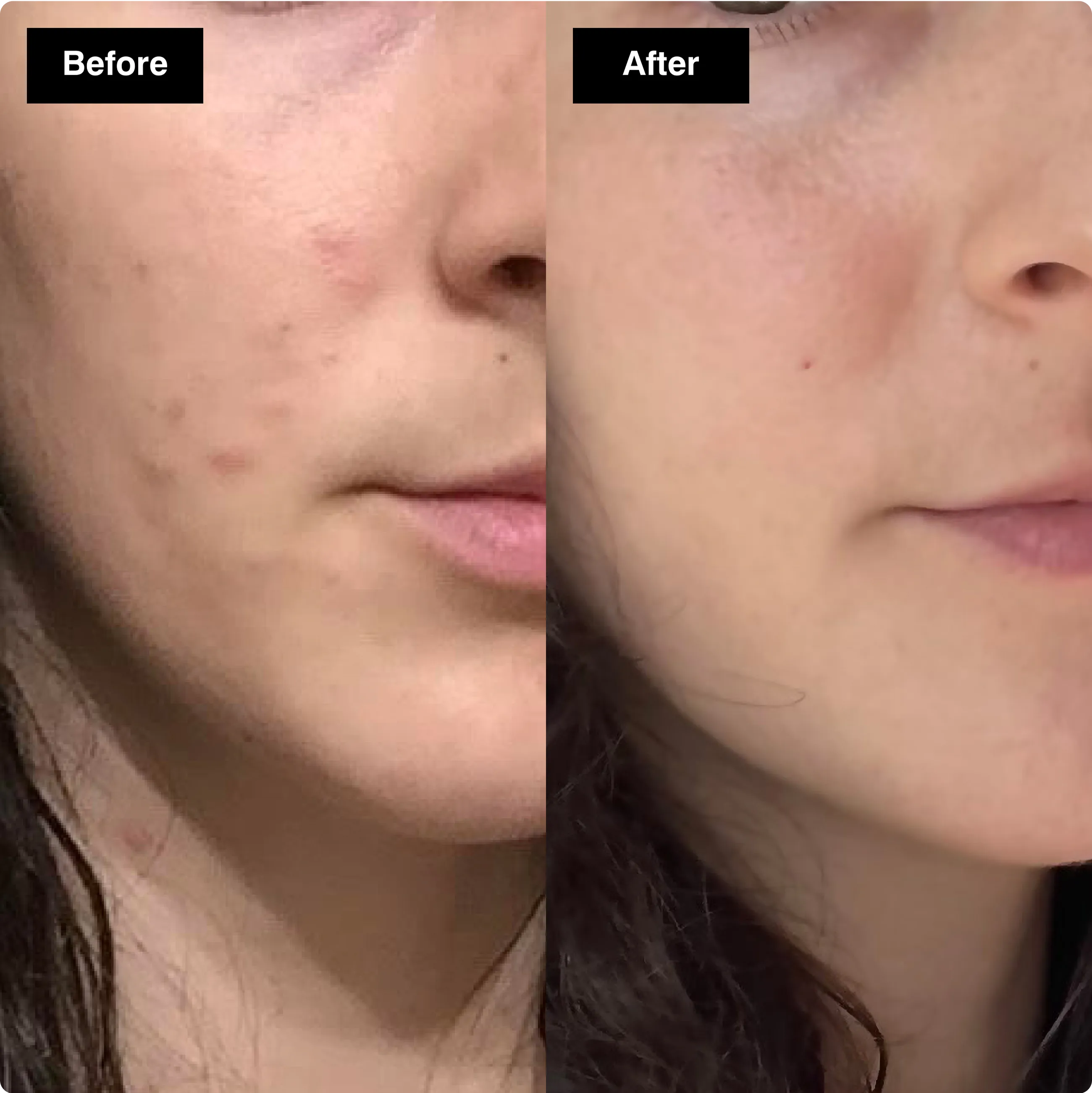 Before and after skincare comparison
showing a side profile with significantly
reduced redness on the cheek.​