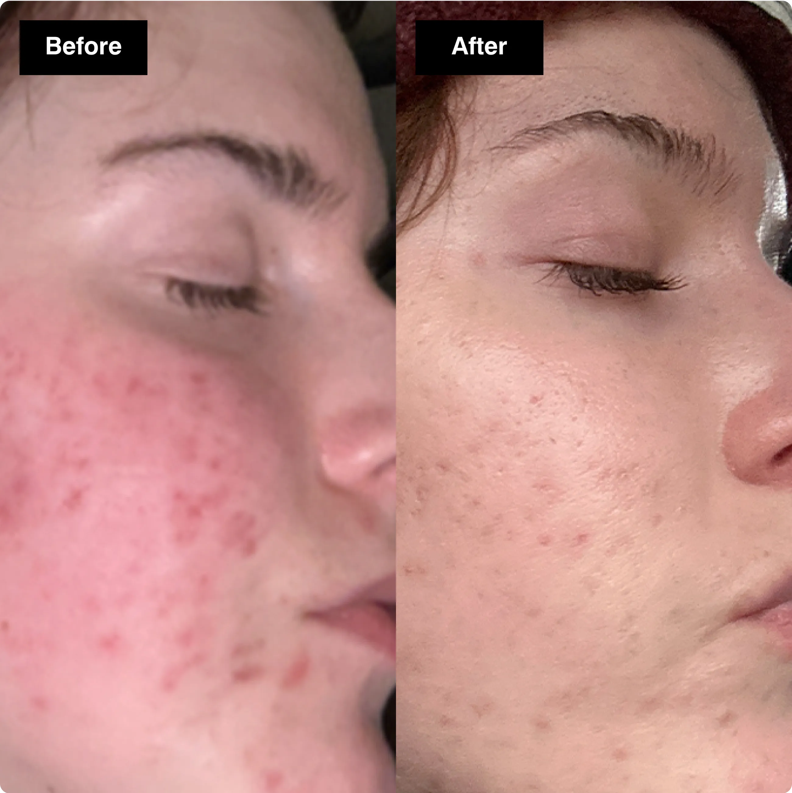 Before and after close-up showing a
dramatic reduction in severe red
blemishes and acne scarring on a cheek.​