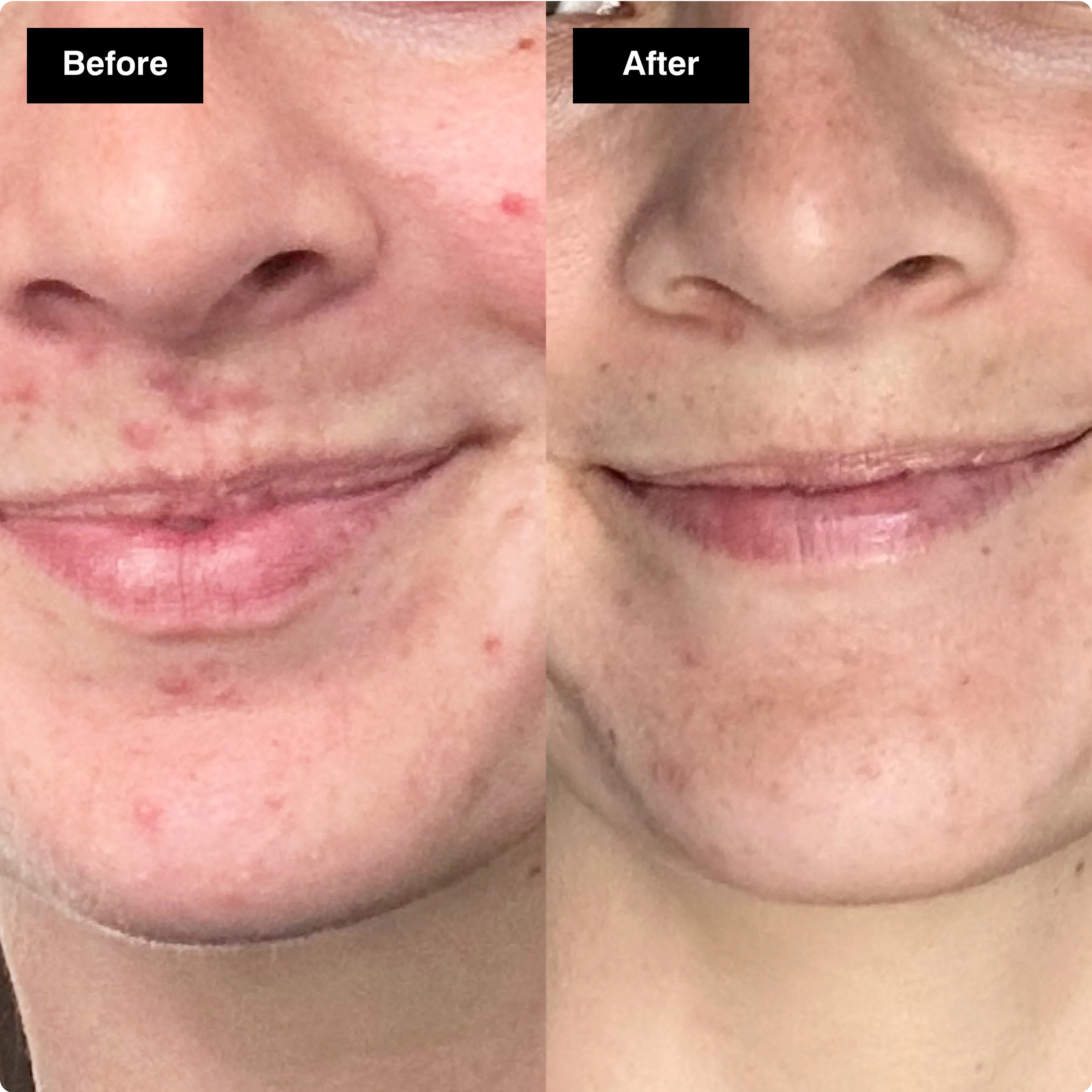 Before and after close-up comparison
showing a noticeable reduction in redness
and blemishes around the mouth and chin.​