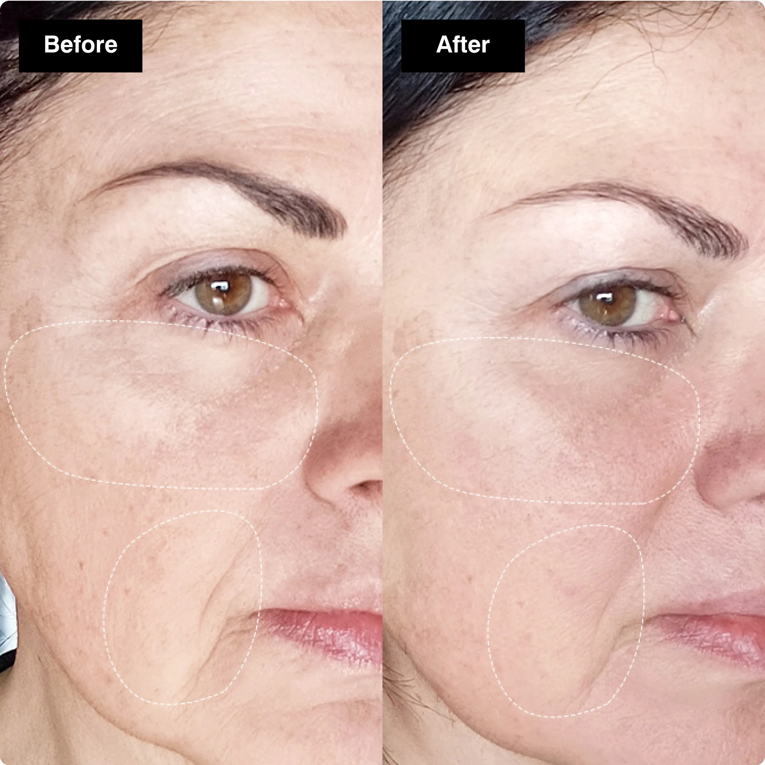 Before and after close-up comparison of a
woman's cheek and eye area, highlighting
reduced fine lines.​