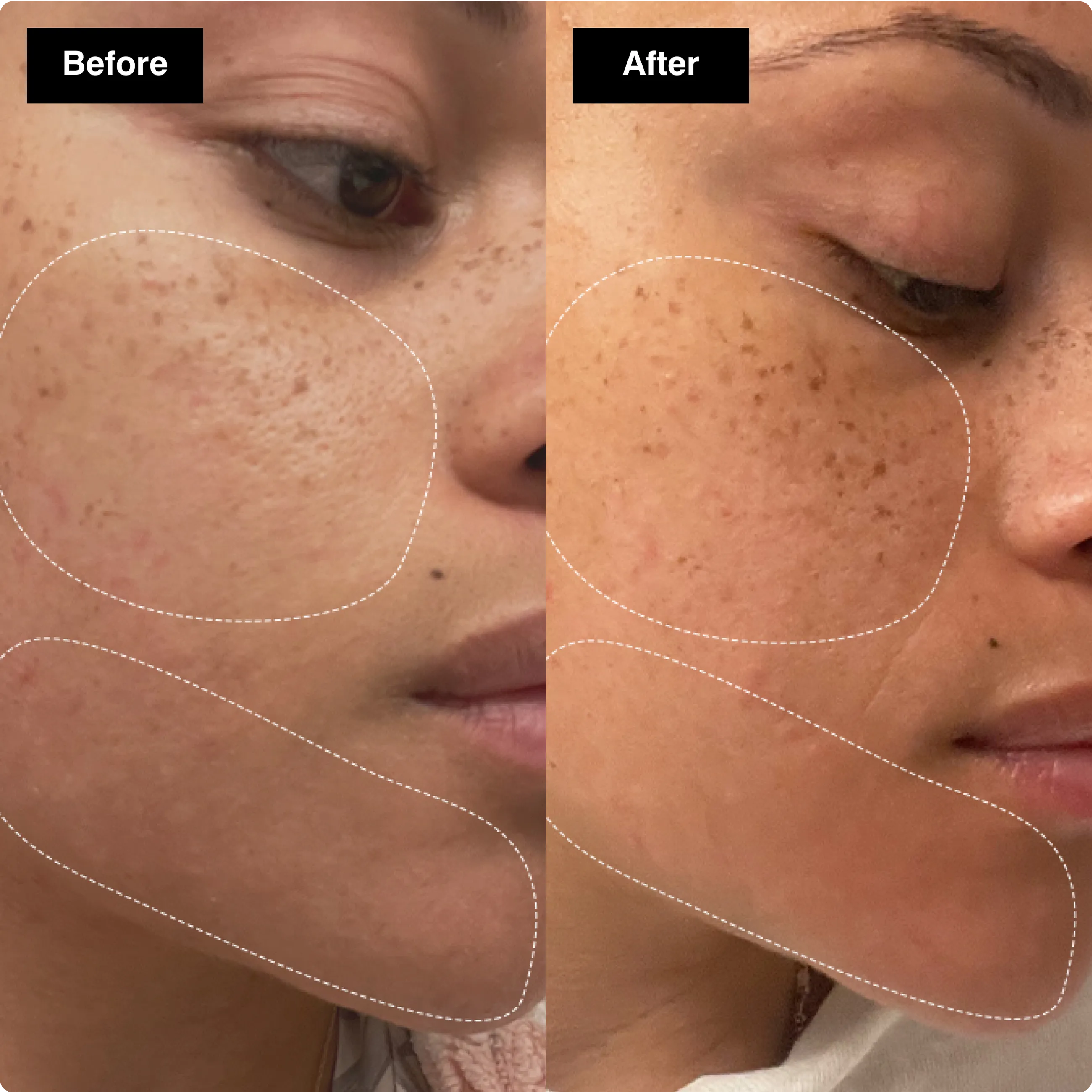 Before and after skincare comparison on a
cheek, highlighting faded dark spots and a
smoother skin texture.​