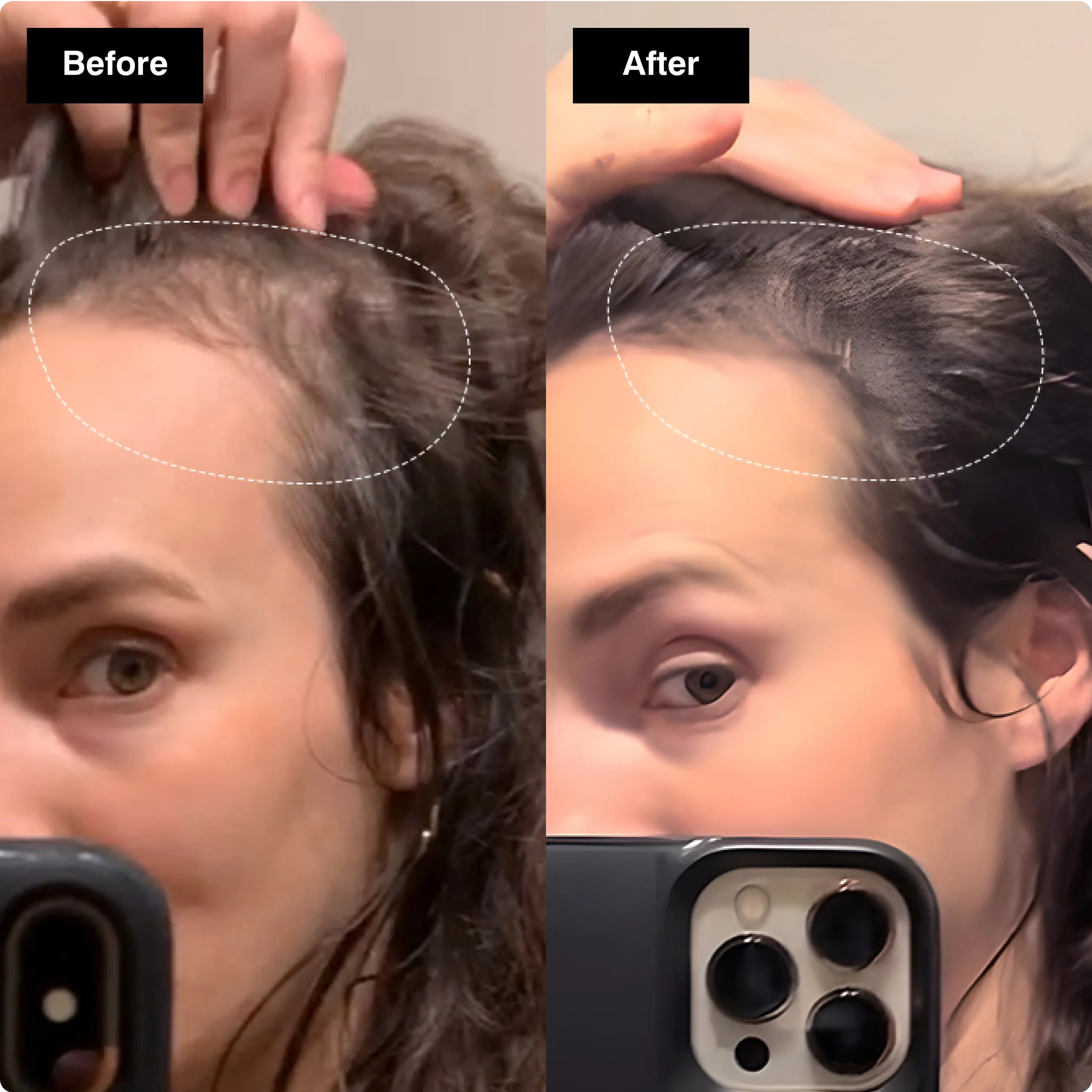Before and after comparison showing a
woman's hairline with noticeably thicker
and denser hair growth.​
