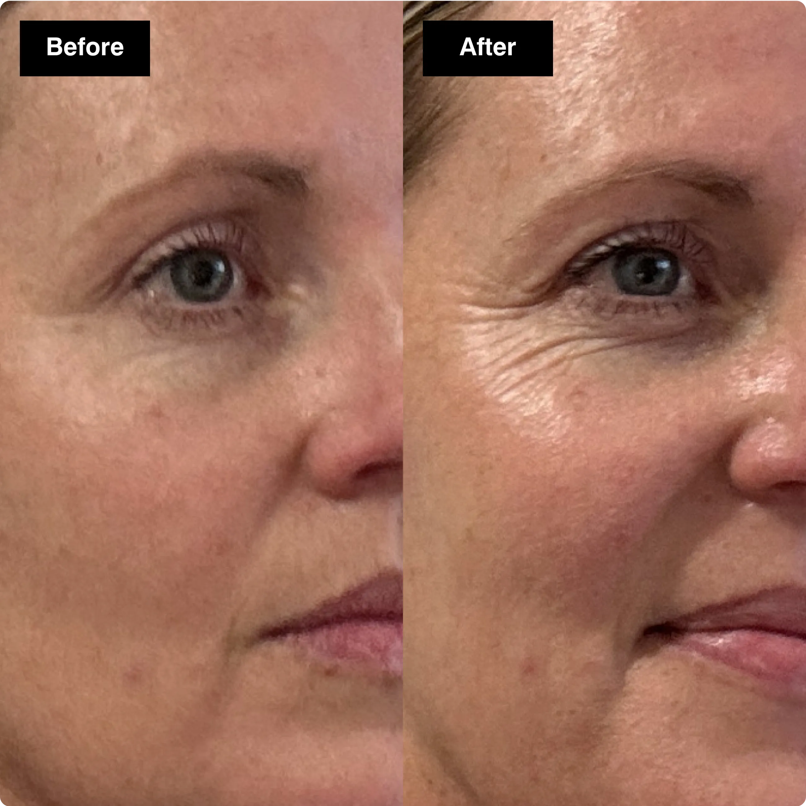 Before and after skincare comparison
focusing on a woman's eye area to show
smoother, hydrated skin.​